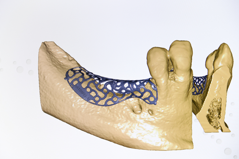 Stomatologia: czy możliwe jest leczenie zaniku kostnego w technologii 3D?