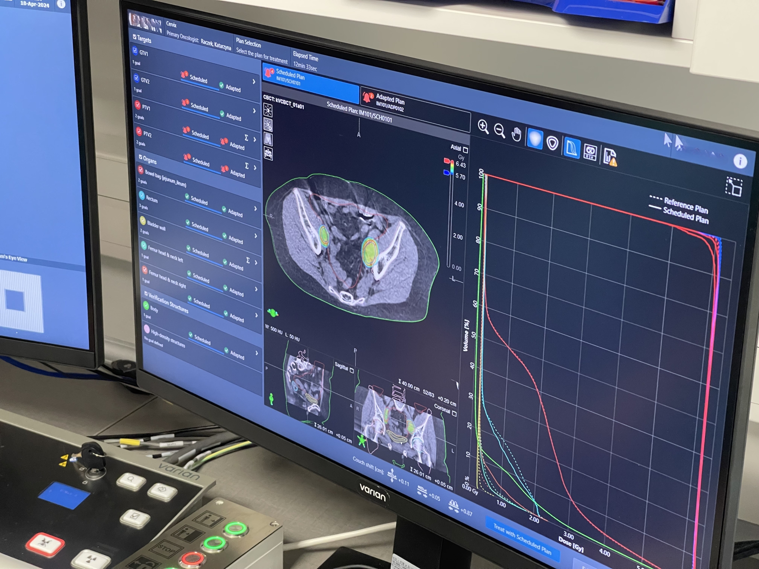 Radioterapia adaptacyjna — nowa jakość w leczeniu promieniami